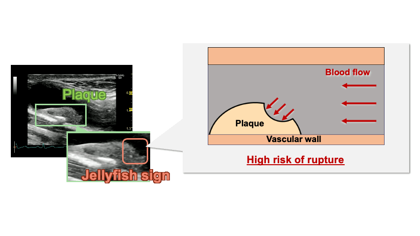Dynamic Plaque Evaluation Based on Ultrasound Video Images